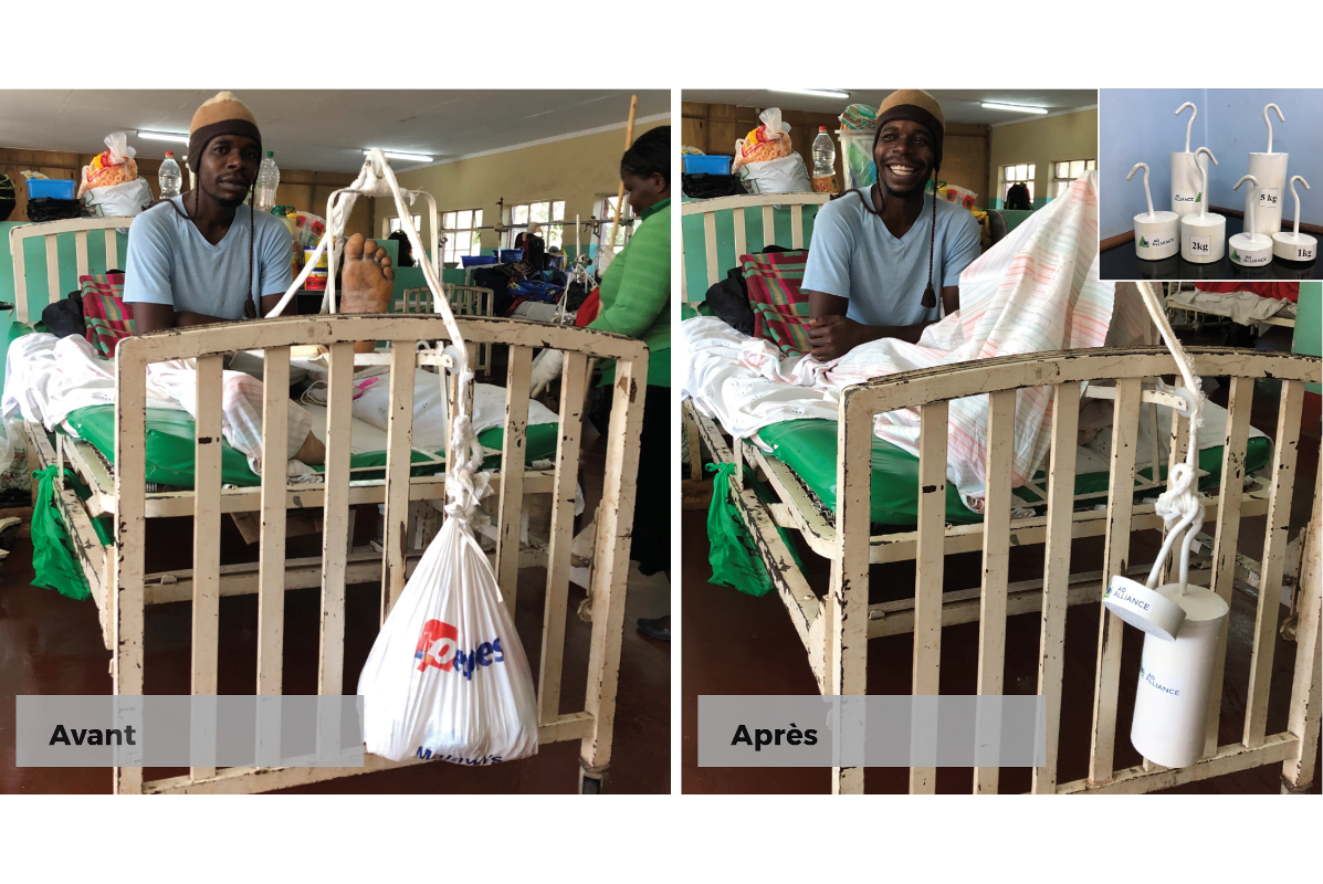 Poids de traction pour les patients blessés au Malawi